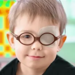 2. Eye patching: Better eye will be patch to force brain to rely on the weaker eye