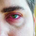 Inflammation: Sometimes your eyelid gets inflamed, leading to a chalazion.