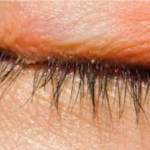 Poor Eyelid Hygiene: Not keeping your eyelids clean can contribute to these bumps.