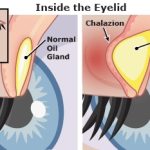 Blocked Oil Gland: Just like skin pores, your eyelids have tiny oil glands that can get clogged.