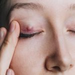 Gentle Massage: Massage the eyelid to help open up the blocked pore.