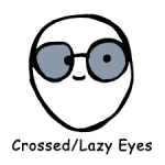 1. Misalignment of the eye (strabismus)