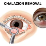 Surgery: In some cases, minor surgery might be needed to drain/remove the lump.