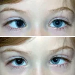 1. Strabismic amblyopia: Due to misalignment of the eye.