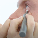 BlephEx: This is a specialized treatment performed by your eye doctor / optometrist to clean your eyelids and remove debris and bacteria that can cause inflammation and blockage.