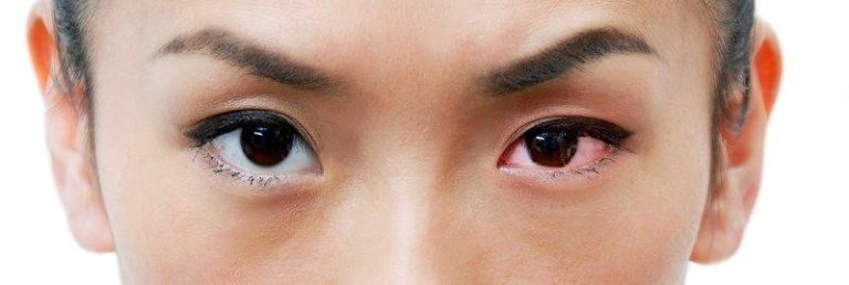 Conjunctivitis